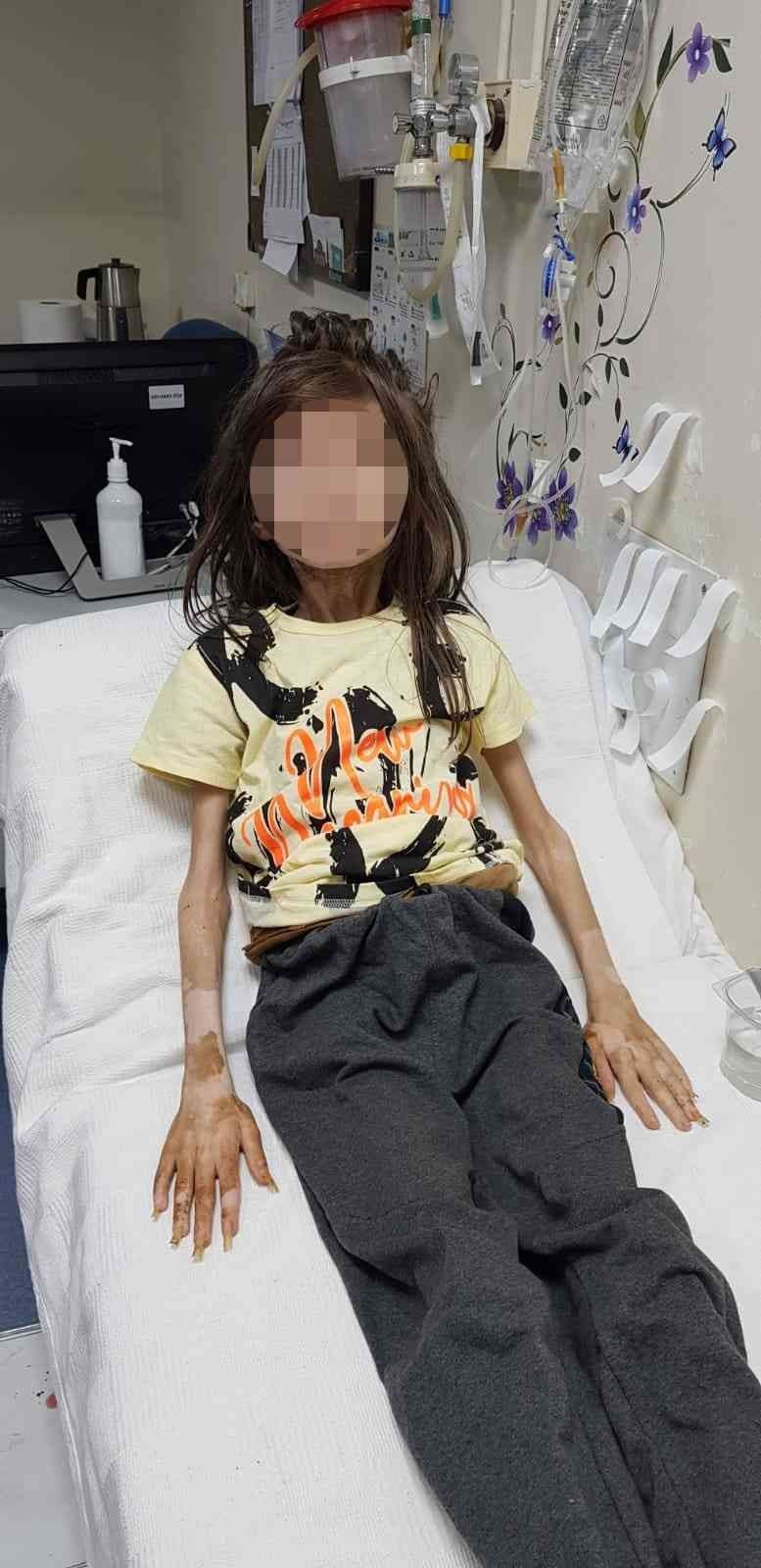 Bursa’da Evde Kilitli Bulunan Çocuk, Antalya Aü Hastanesi’nde Tedaviye Alındı