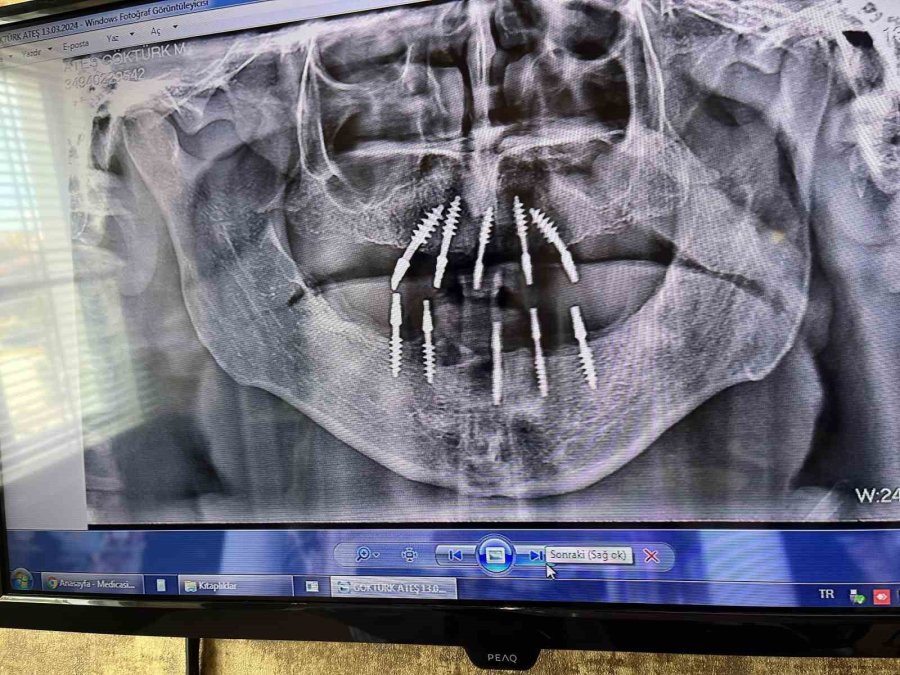 Fizyomer Diş Hekimi Monoblok İmplantın Avantajlarından Bahsetti