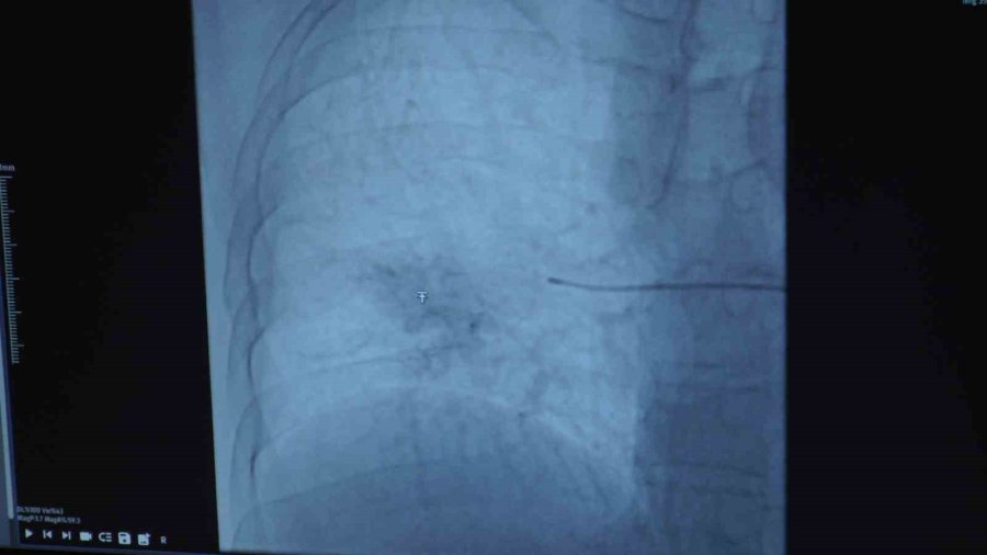 Ölümcül Kanamalarından ‘embolizasyon’ Sayesinde Kurtuldu
