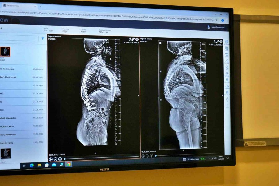 Doğuştan Skolyoz Hastası Kırgız Genç Kızın Boyu, 20 Yaşında 10 Cm Uzadı